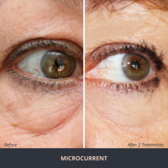 Microcurrent Non Surgical Facelift Novuskin