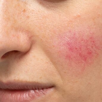 Rosacea is a skin problem characterized by a red face and cheeks. But rosacea is more than just skin redness, and the symptoms can progress as the condition worsens.
