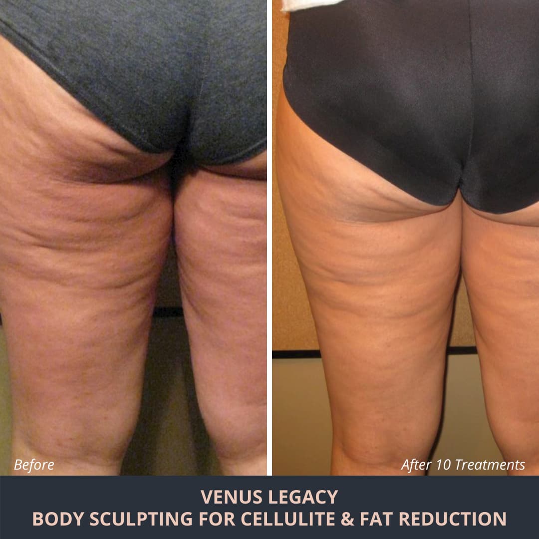 How To Get Rid of Cellulite: Treatment & Lifestyle Changes – Dermatology  Associates of Rochester