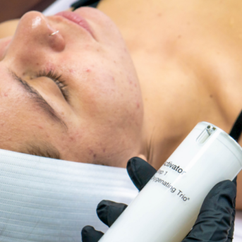 Everything you Need to Know About Chemical Peels