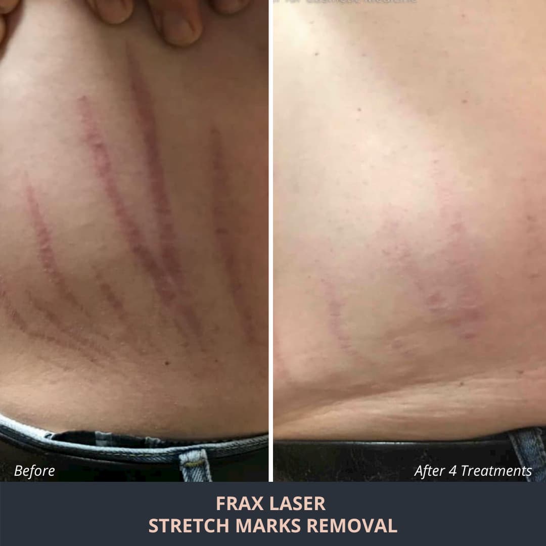 Laser stretch mark removal tampa