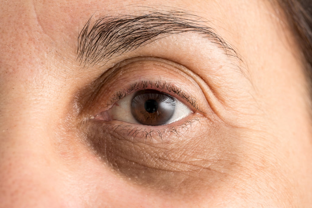 Puffy Eyes and How To Treat Them