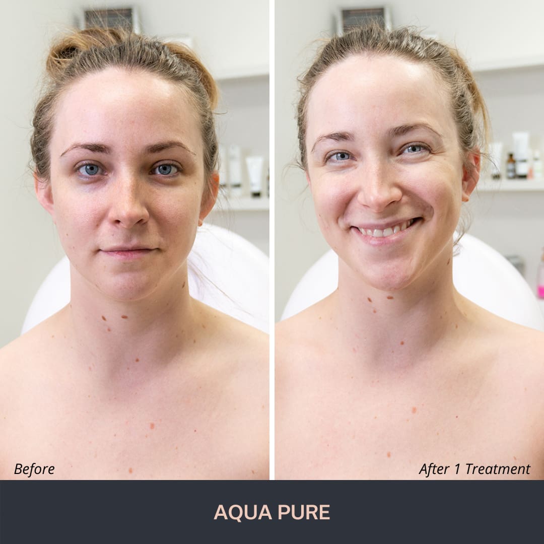 Aquapure - Único sistema de cuidado facial inteligente - Reference Medical