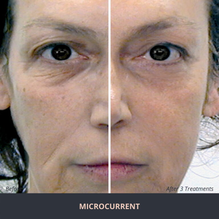 Microcurrent non surgical facelift Novuskin