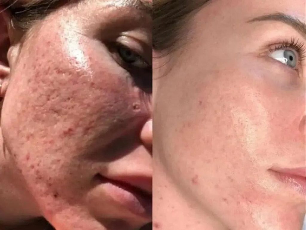 Acne Scars vanished with treatment