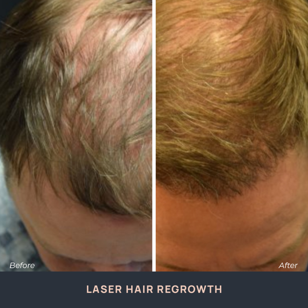 Laser Hair Regrowth Treatment Novuskin 0982